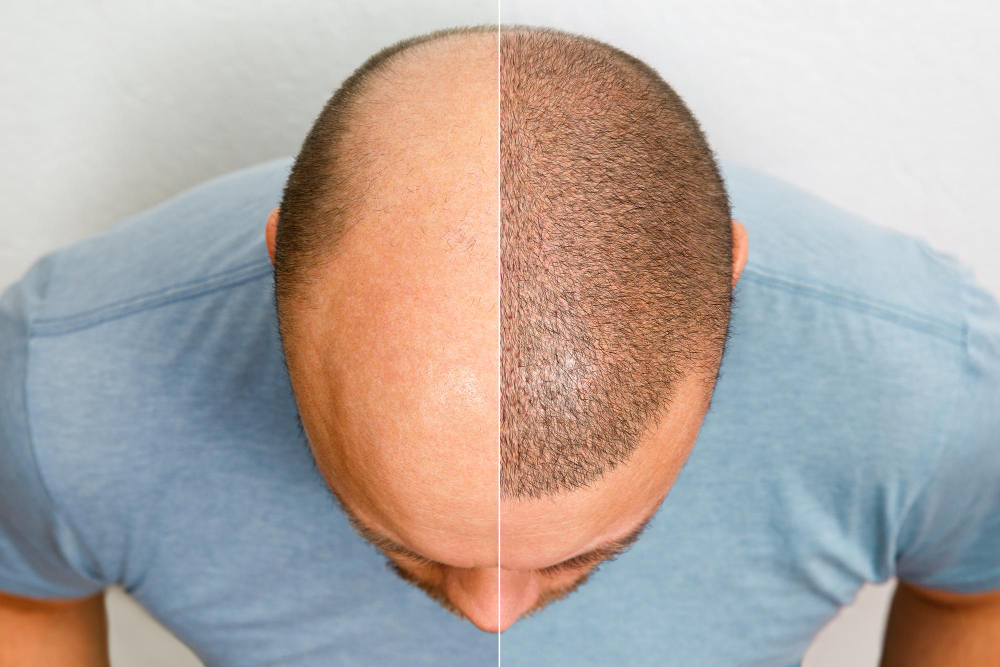Hair Transplant With Pain Free
